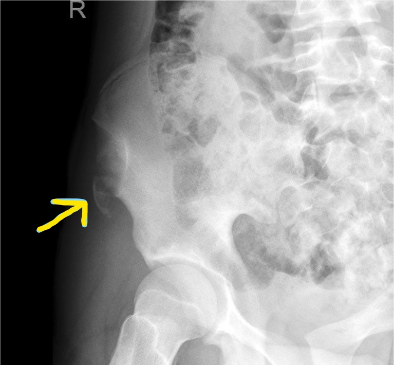 Avulsion Fracture ASIS LI