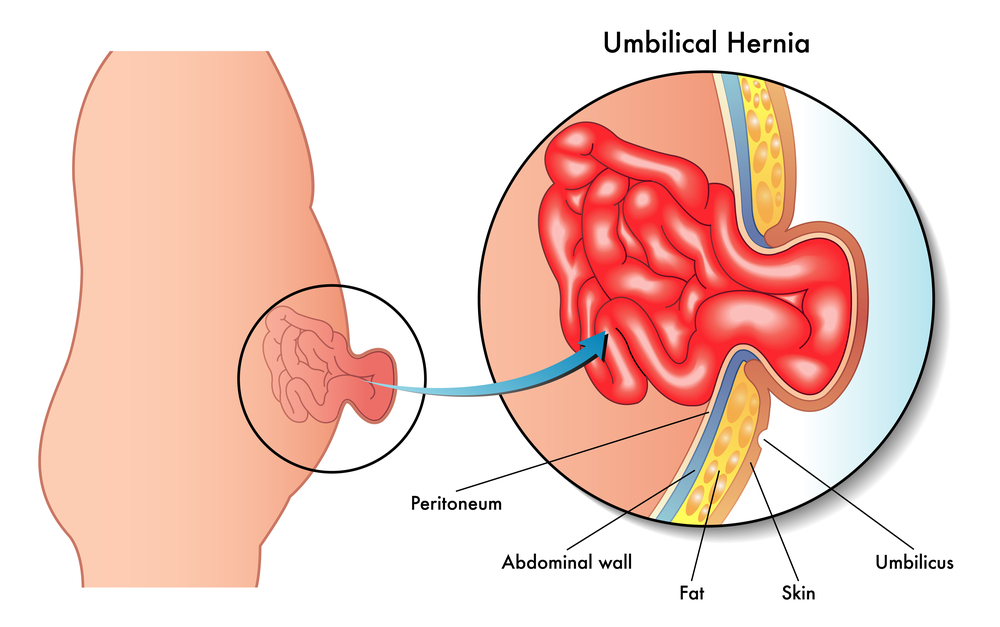 Abdominal hernia