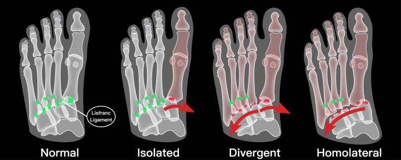 LisFrancs fracture small