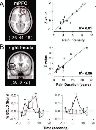 Spontaneous brain activity in chronic low back pain