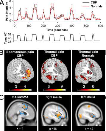 Brain activity to thermal stimuli in CLBP
