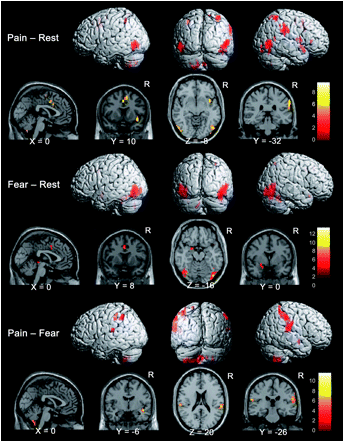 Pain and Fear Brain imaging