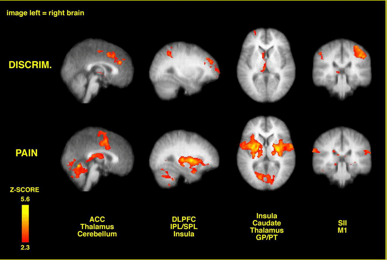Brain imaging of spatial discrmination versus perceived pain