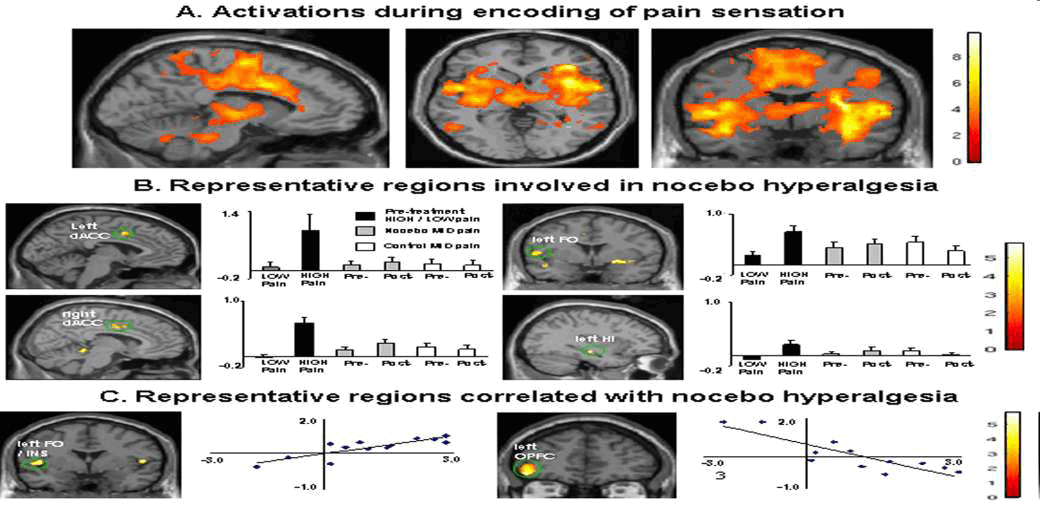 Nocebo hyperalgesia