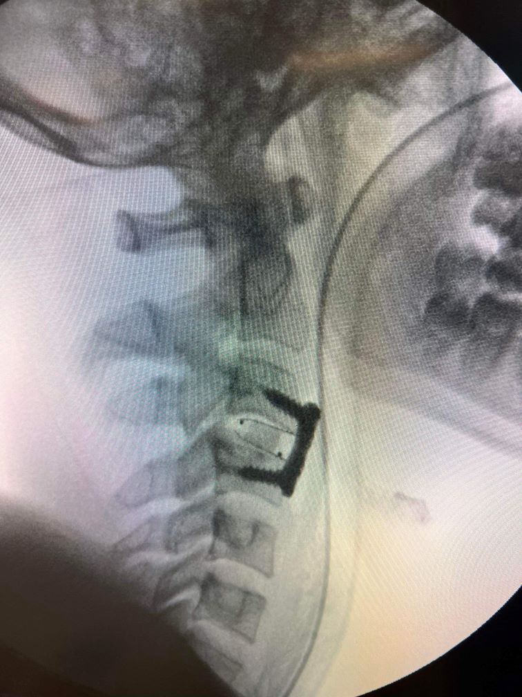 Neck Fracture Small