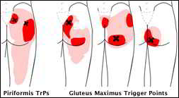 si joint pain referral patterns