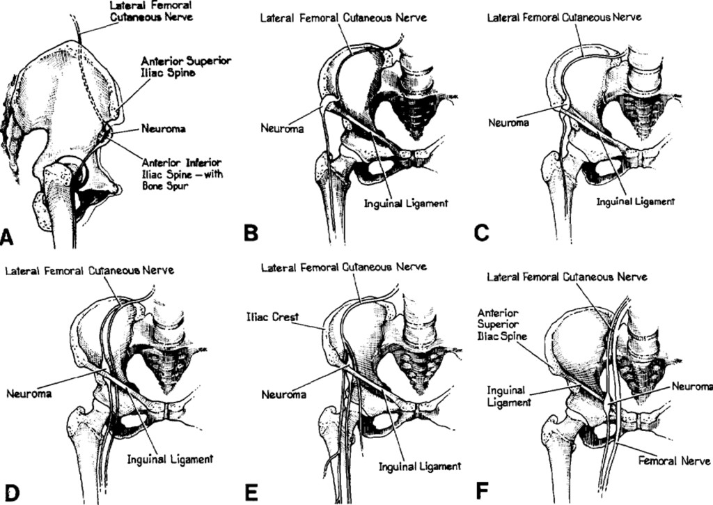 Lateral Femoral Cutaneous Nerve