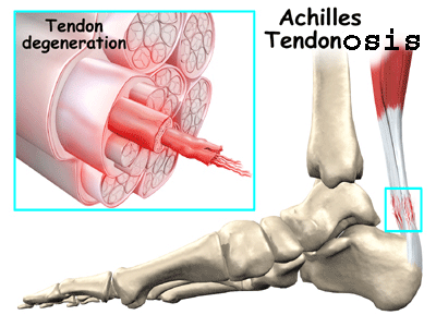 Achilles-Tendonosis