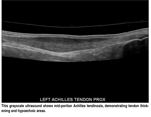 Achilles tendonosis ultrasound