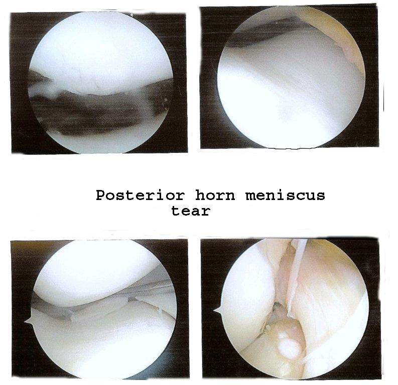meniscus3