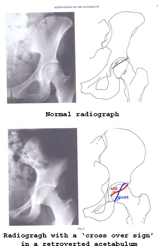 Pelvic Girdle Instability