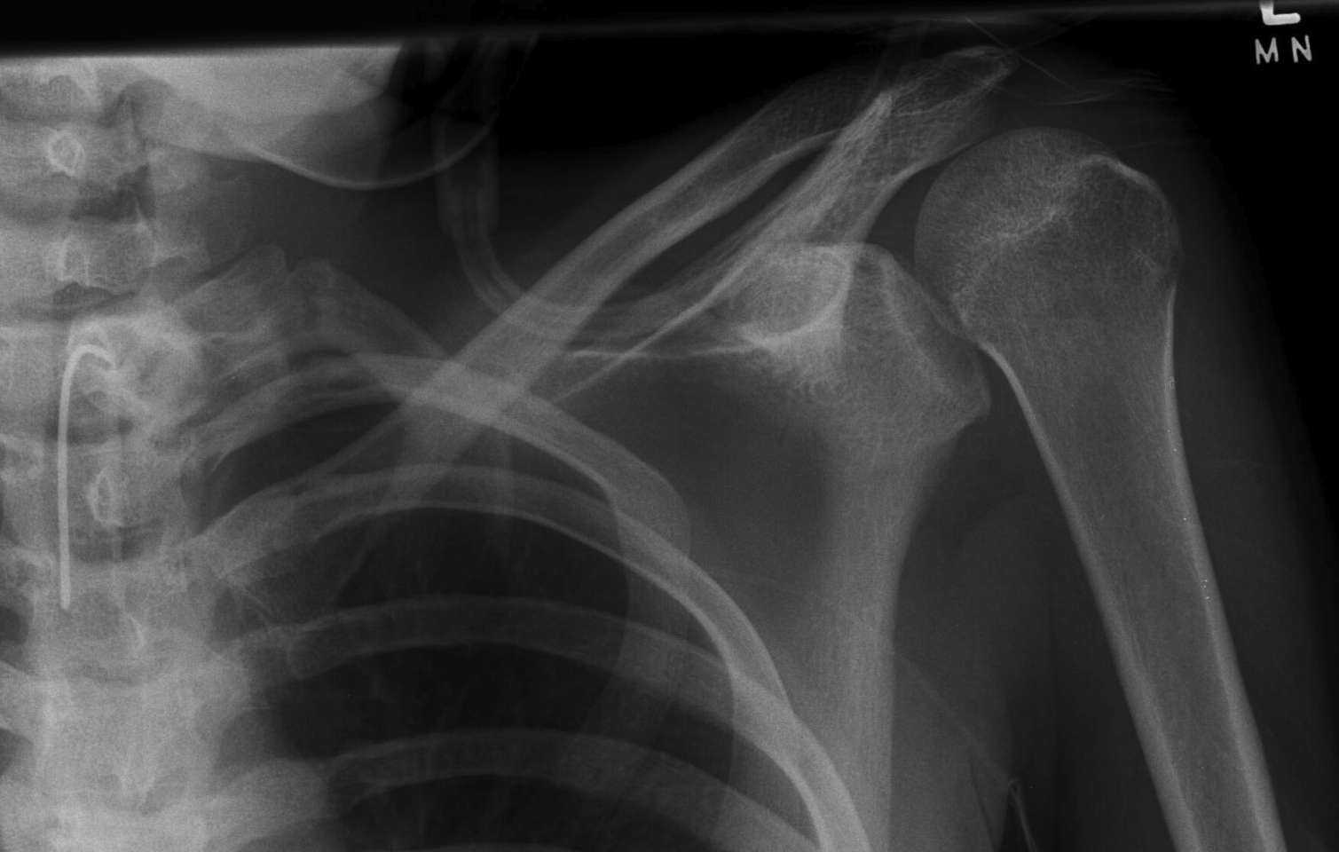 posterior-shoulder-dislocation1