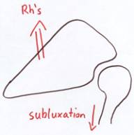 Line of action of the rhomboid muscles and glenohumeral instability