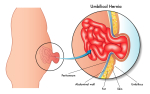 Injury blog: Abdominal hernias