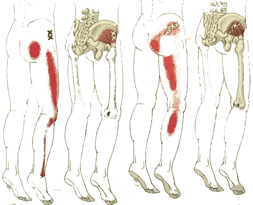 Trigger point - gluteus medius