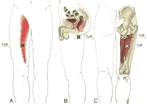 Trigger Point - adductor magnus. Note the anal referral which is common amongst cyclists who use the adductors to power hip extension